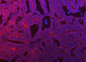 Immunofluorescent staining of FFPE human ovarian cancer tissue with SerRS antibody (red) and DAPI nuclear stain (blue). HIER: steam section in pH8 EDTA buffer for 20 min.