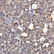 IHC staining of FFPE human thyroid cancer tissue with SerRS antibody. HIER: boil tissue sections in pH8 EDTA for 20 min and allow to cool before testing.