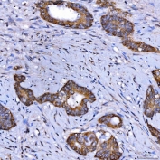IHC staining of FFPE human colon cancer tissue with SerRS antibody. HIER: boil tissue sections in pH8 EDTA for 20 min and allow to cool before testing.
