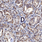 IHC staining of FFPE human prostate adenocarcinoma tissue with SerRS antibody. HIER: boil tissue sections in pH8 EDTA for 20 min and allow to cool before testing.