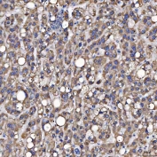 IHC staining of FFPE human liver cancer tissue with SerRS antibody. HIER: boil tissue sections in pH8 EDTA for 20 min and allow to cool before testing.