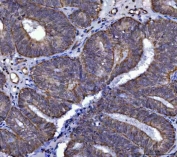 IHC staining of FFPE human endometrial cancer tissue with SerRS antibody. HIER: boil tissue sections in pH8 EDTA for 20 min and allow to cool before testing.