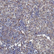 IHC staining of FFPE human cervical cancer tissue with SerRS antibody. HIER: boil tissue sections in pH8 EDTA for 20 min and allow to cool before testing.