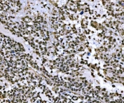 IHC staining of FFPE human breast cancer tissue with THAP11 antibody. HIER: boil tissue sections in pH8 EDTA for 20 min and allow to cool before testing.