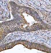 IHC staining of FFPE human colorectal adenocarcinoma tissue with THAP11 antibody. HIER: boil tissue sections in pH8 EDTA for 20 min and allow to cool before testing.