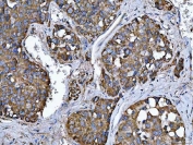 IHC staining of FFPE human liver cancer tissue with TMPRSS13 antibody. HIER: boil tissue sections in pH8 EDTA for 20 min and allow to cool before testing.