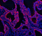 Immunofluorescent staining of FFPE human intestinal cancer tissue with TMPRSS13 antibody (red) and DAPI nuclear stain (blue). HIER: steam section in pH8 EDTA buffer for 20 min.