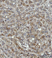 IHC staining of FFPE human liver cancer tissue with Thrombospondin-3 antibody. HIER: boil tissue sections in pH8 EDTA for 20 min and allow to cool before testing.
