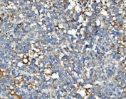 IHC staining of FFPE human breast cancer tissue with Thrombospondin-3 antibody. HIER: boil tissue sections in pH8 EDTA for 20 min and allow to cool before testing.