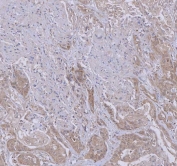 IHC staining of FFPE human breast cancer tissue with WDR44 antibody. HIER: boil tissue sections in pH8 EDTA for 20 min and allow to cool before testing.