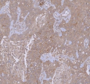 IHC staining of FFPE human testis cancer tissue with WDR44 antibody. HIER: boil tissue sections in pH8 EDTA for 20 min and allow to cool before testing.