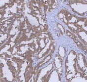 IHC staining of FFPE human ovarian cancer tissue with WDR44 antibody. HIER: boil tissue sections in pH8 EDTA for 20 min and allow to cool before testing.