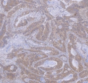 IHC staining of FFPE human colon cancer tissue with WDR44 antibody. HIER: boil tissue sections in pH8 EDTA for 20 min and allow to cool before testing.