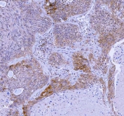 IHC staining of FFPE human lung cancer tissue with WDR44 antibody. HIER: boil tissue sections in pH8 EDTA for 20 min and allow to cool before testing.