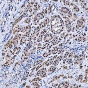 IHC staining of FFPE human prostate cancer tissue with SCML1 antibody. HIER: boil tissue sections in pH8 EDTA for 20 min and allow to cool before testing.