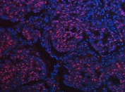 Immunofluorescent staining of FFPE human lung squamous cell carcinoma tissue with SCML1 antibody (red) and DAPI nuclear stain (blue). HIER: steam section in pH8 EDTA buffer for 20 min.