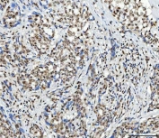 IHC staining of FFPE human lung adenocarcinoma tissue with SCML1 antibody. HIER: boil tissue sections in pH8 EDTA for 20 min and allow to cool before testing.