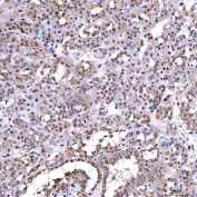 IHC staining of FFPE human thyroid cancer tissue with SCML1 antibody. HIER: boil tissue sections in pH8 EDTA for 20 min and allow to cool before testing.