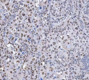 IHC staining of FFPE human laryngeal squamous cell carcinoma tissue with SCML1 antibody. HIER: boil tissue sections in pH8 EDTA for 20 min and allow to cool before testing.