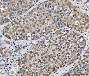 IHC staining of FFPE human liver cancer tissue with SCML1 antibody. HIER: boil tissue sections in pH8 EDTA for 20 min and allow to cool before testing.