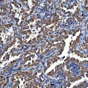 IHC staining of FFPE human lung cancer tissue with SDF2L1 antibody. HIER: boil tissue sections in pH8 EDTA for 20 min and allow to cool before testing.