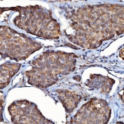 IHC staining of FFPE human breast cancer tissue with SDF2L1 antibody. HIER: boil tissue sections in pH8 EDTA for 20 min and allow to cool before testing.