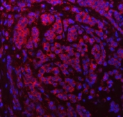 Immunofluorescent staining of FFPE human breast cancer tissue with SDF2L1 antibody (red) and DAPI nuclear stain (blue). HIER: steam section in pH8 EDTA buffer for 20 min.