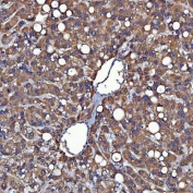 IHC staining of FFPE human liver cancer tissue with SDF2L1 antibody. HIER: boil tissue sections in pH8 EDTA for 20 min and allow to cool before testing.