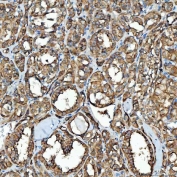 IHC staining of FFPE human thyroid cancer tissue with SDF2L1 antibody. HIER: boil tissue sections in pH8 EDTA for 20 min and allow to cool before testing.