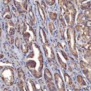 IHC staining of FFPE human prostate cancer tissue with SDF2L1 antibody. HIER: boil tissue sections in pH8 EDTA for 20 min and allow to cool before testing.