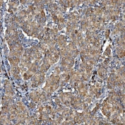 IHC staining of FFPE human cervical cancer tissue with SDF2L1 antibody. HIER: boil tissue sections in pH8 EDTA for 20 min and allow to cool before testing.