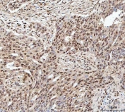 IHC staining of FFPE human ovarian serous adenocarcinoma tissue with SDE2 antibody. HIER: boil tissue sections in pH8 EDTA for 20 min and allow to cool before testing.