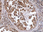 IHC staining of FFPE human lung adenocarcinoma tissue with SDE2 antibody. HIER: boil tissue sections in pH8 EDTA for 20 min and allow to cool before testing.