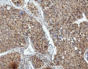 IHC staining of FFPE human liver cancer tissue with SDE2 antibody. HIER: boil tissue sections in pH8 EDTA for 20 min and allow to cool before testing.