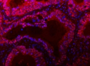 Immunofluorescent staining of FFPE human colon cancer tissue with TIGD1 antibody (red) and DAPI nuclear stain (blue). HIER: steam section in pH8 EDTA buffer for 20 min.
