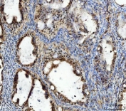 IHC staining of FFPE human ovarian cancer tissue with TIGD1 antibody. HIER: boil tissue sections in pH8 EDTA for 20 min and allow to cool before testing.