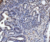 IHC staining of FFPE human cervical cancer tissue with TIGD1 antibody. HIER: boil tissue sections in pH8 EDTA for 20 min and allow to cool before testing.