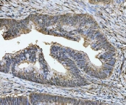 IHC staining of FFPE human colorectal adenocarcinoma tissue with TIGD1 antibody. HIER: boil tissue sections in pH8 EDTA for 20 min and allow to cool before testing.
