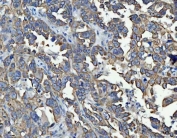 IHC staining of FFPE human ovarian cancer tissue with TRAM1L1 antibody. HIER: boil tissue sections in pH8 EDTA for 20 min and allow to cool before testing.