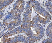 IHC staining of FFPE human colorectal adenocarcinoma tissue with TRAM1L1 antibody. HIER: boil tissue sections in pH8 EDTA for 20 min and allow to cool before testing.