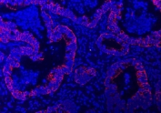 Immunofluorescent staining of FFPE human colorectal adenocarcinoma tissue with TRAM1L1 antibody (red) and DAPI nuclear stain (blue). HIER: steam section in pH8 EDTA buffer for 20 min.