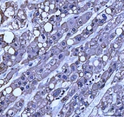 IHC staining of FFPE human liver cancer tissue with TRAM1L1 antibody. HIER: boil tissue sections in pH8 EDTA for 20 min and allow to cool before testing.
