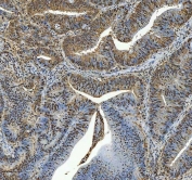 IHC staining of FFPE human intestinal cancer tissue with TRIR antibody. HIER: boil tissue sections in pH8 EDTA for 20 min and allow to cool before testing.