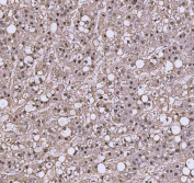 IHC staining of FFPE human liver cancer tissue with TRIR antibody. HIER: boil tissue sections in pH8 EDTA for 20 min and allow to cool before testing.