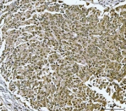IHC staining of FFPE human lung cancer tissue with TWIST1/2 antibody. HIER: boil tissue sections in pH8 EDTA for 20 min and allow to cool before testing.