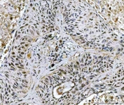 IHC staining of FFPE human lung squamous cell carcinoma tissue with TWIST1/2 antibody. HIER: boil tissue sections in pH8 EDTA for 20 min and allow to cool before testing.