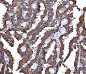 IHC staining of FFPE human ovarian cancer tissue with FRY antibody. HIER: boil tissue sections in pH8 EDTA for 20 min and allow to cool before testing.