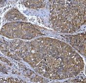 IHC staining of FFPE human liver cancer tissue with FRY antibody. HIER: boil tissue sections in pH8 EDTA for 20 min and allow to cool before testing.