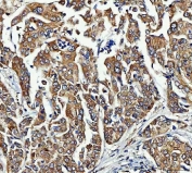 IHC staining of FFPE human lung cancer tissue with FRY antibody. HIER: boil tissue sections in pH8 EDTA for 20 min and allow to cool before testing.