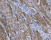 IHC staining of FFPE human penis squamous cell carcinoma tissue with FRY antibody. HIER: boil tissue sections in pH8 EDTA for 20 min and allow to cool before testing.